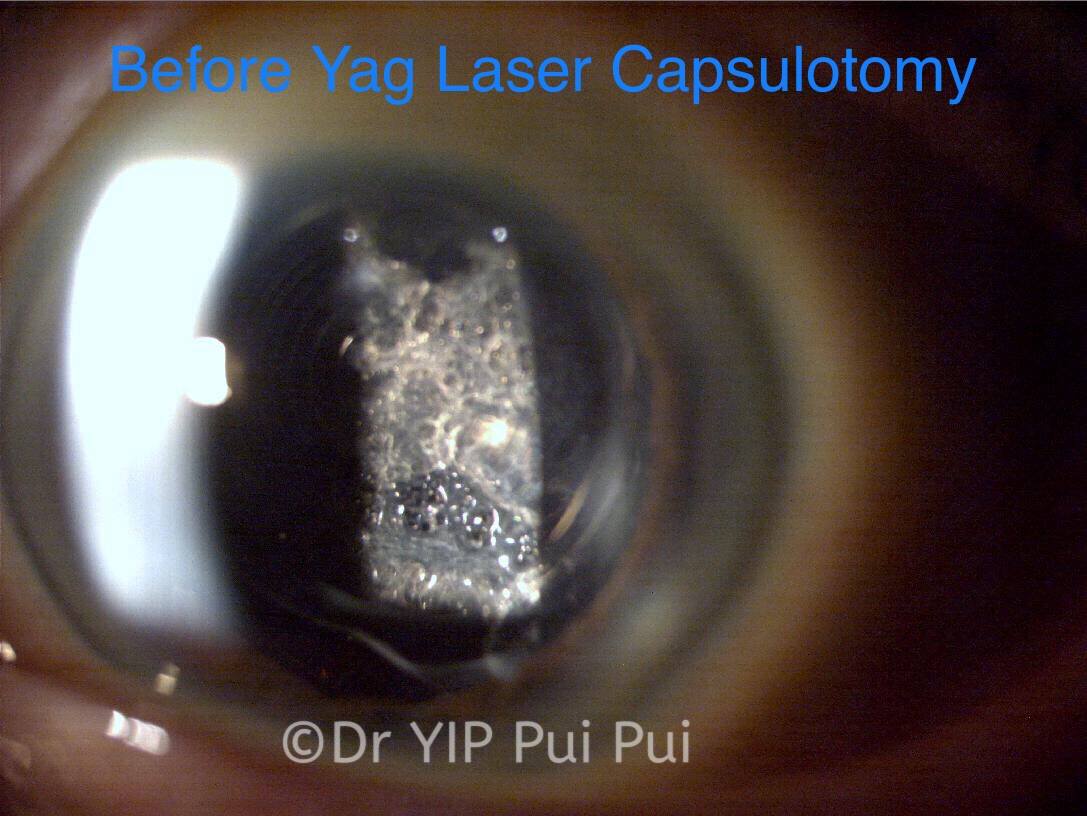 經濟日報：白內障手術後視力再倒退 或是2件事作怪